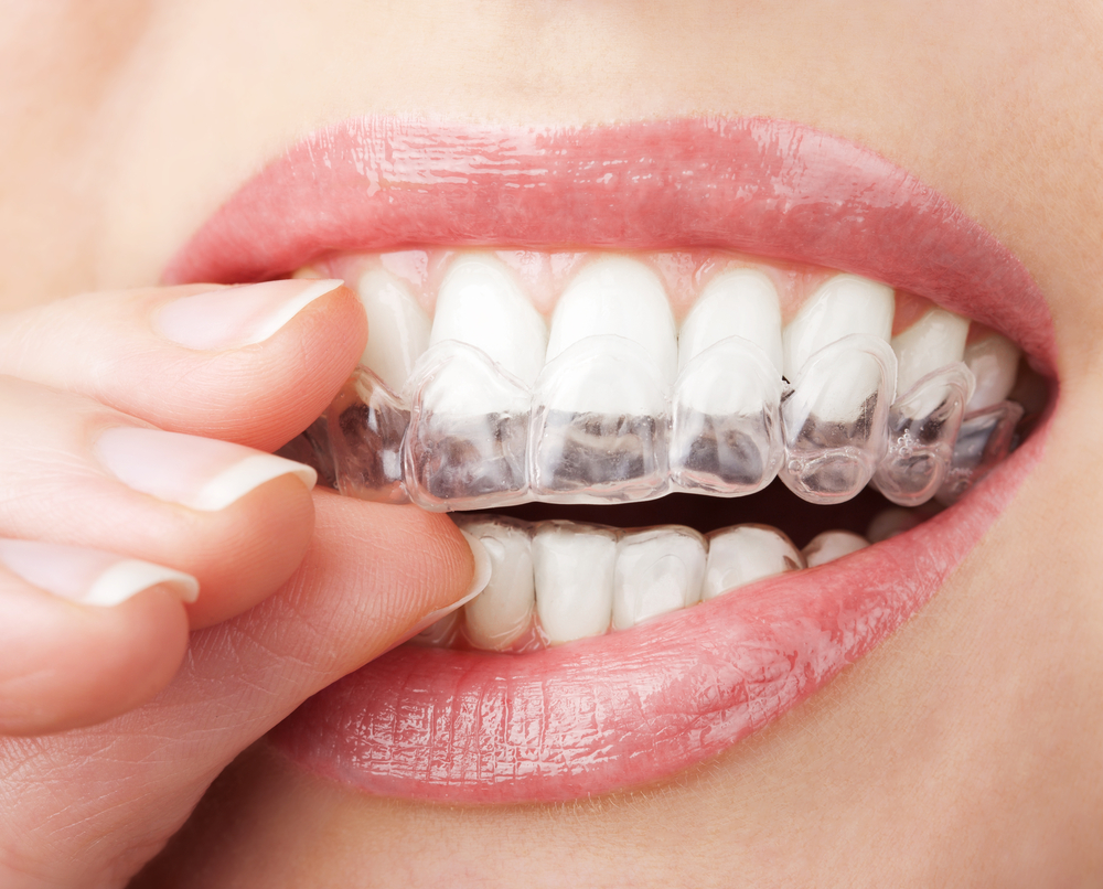 INVISALIGN na Clínica PRIVÉ