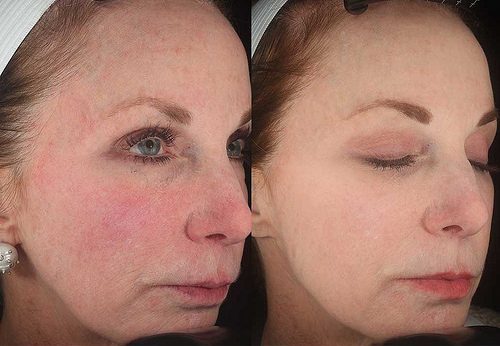 Laser Vbeam na Clínica PRIVÉ