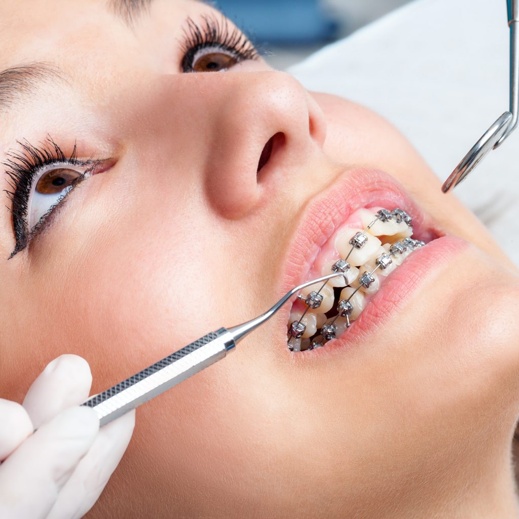 Tratar dentes tortos na Clínica PRIVÉ