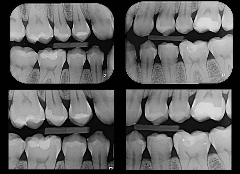 Radiografia Interproximal Como Fazer - EDUBRAINAZ